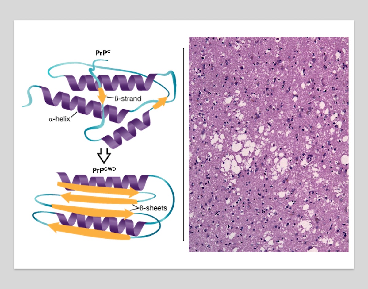 A graphic with an illustration on the left and a microscopic image of brain tissue on the right. The illustration shows a comparison between the normal prion protein PRPC and the misfolded prion protein PRPCWD. The image to the right is of pink brain tissue with damage or white holes caused from accumulation of PRPCWD.
